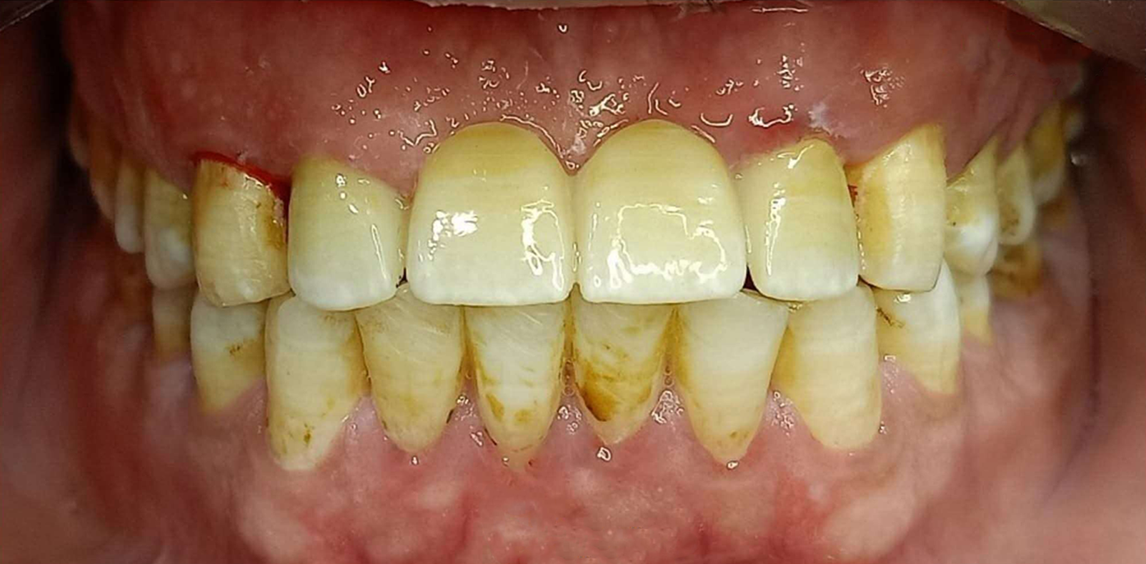 بعد — علاج تسوس طفل